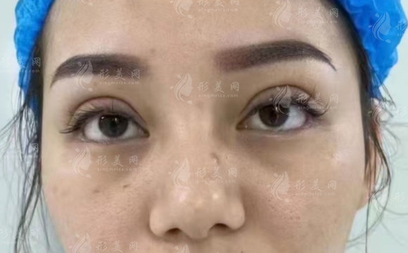 石家庄双眼皮修复医院哪家好？五强机构技术强价格透明