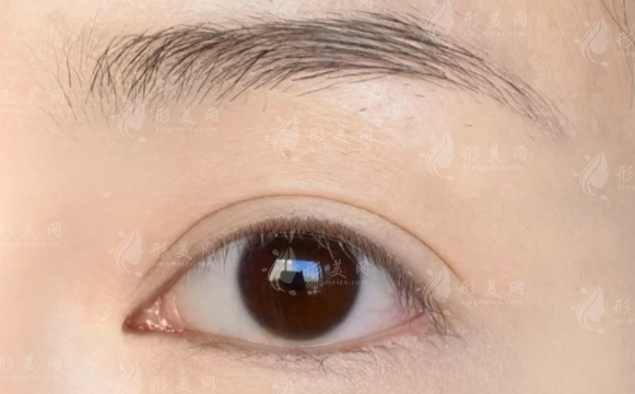 温州割双眼皮医院哪家好？五强机构技术强价格透明