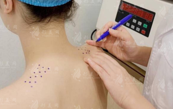 打完瘦肩针别躺平!这份术后护理宝典让你美肩持久