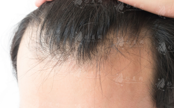 厦门曙光植发医院靠谱吗?李江滨/童靖技术口碑双在线