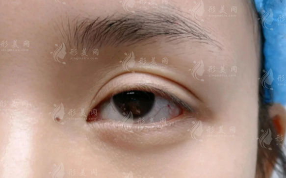 成都双眼皮修复哪位医生好?林靖/高亮/卢尚兵口碑实测