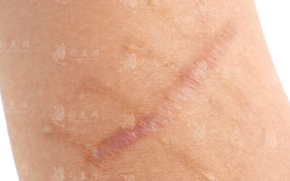 昆明昆大疤痕医院祛疤好吗?2026年新价格表+医生团队全解析