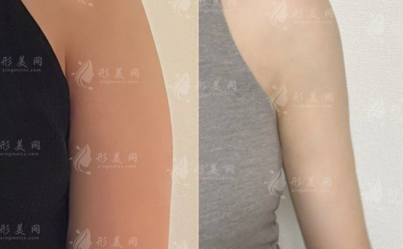 南京米嘉徐鹤然吸脂靠谱吗?脂肪填充+威塑抽脂技术解析