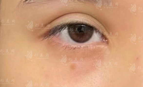 上海马娟双眼皮修复口碑揭秘：自然无痕技术获认可