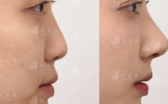 深圳张辉赫本鼻技术解析：精致鼻型打造攻略