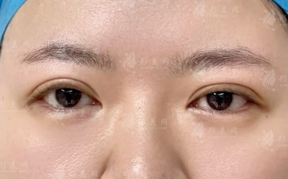 双眼皮做宽了能改窄吗?修复避坑指南+医生推荐