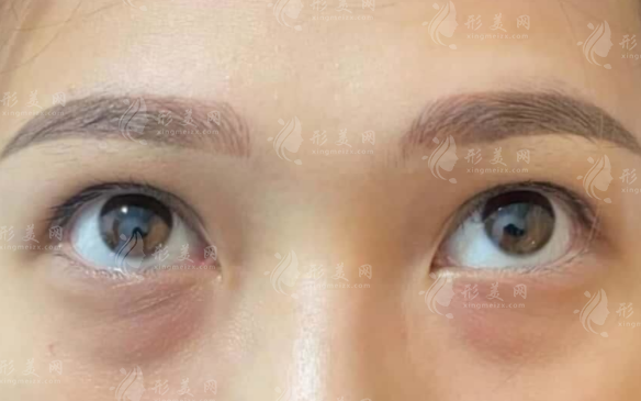 泪沟填充选胶原蛋白还是玻尿酸?维持时间效果对比