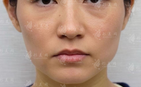 童颜线提升多少钱?2026价格揭秘+适合人群分析 童颜线提升多少钱?2026价格揭秘+适合人群分析