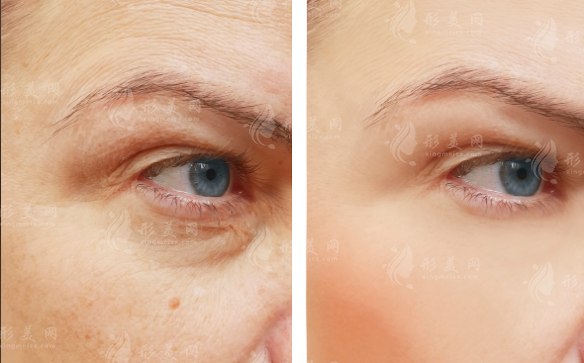 武汉不开刀去眼袋哪家好?排名前五医院技术口碑双在线 武汉不开刀去眼袋哪家好?排名前五医院技术口碑双在线