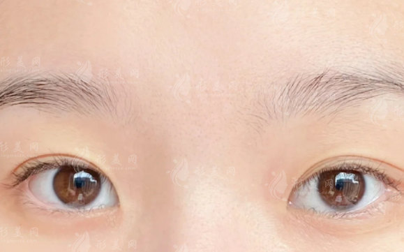 西安双眼皮避坑指南：这10家正规医院闭眼入不踩雷