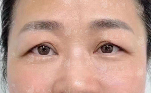 张冰洁眼修复靠谱吗?20年经验+上万案例深度解析