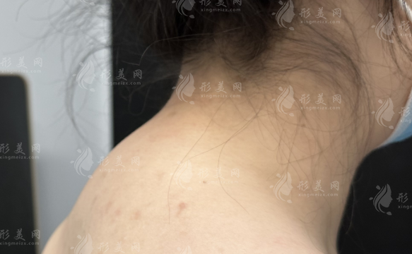 郑州刘学宝富贵包手术怎么样?微创技术深度解析