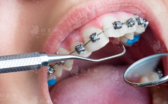 2026广州德伦口腔价目表！种植牙/矫正收费+18家门店地址