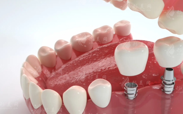 2026苏州牙科价目表更新!种植牙矫正收费实惠攻略 2026苏州牙科价目表更新!种植牙矫正收费实惠攻略