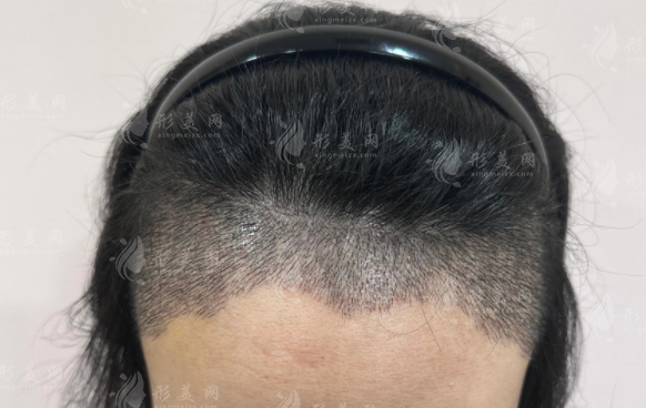 M型发际线拯救指南:山羊角秃额角3种修复方案对比 M型发际线拯救指南:山羊角秃额角3种修复方案对比