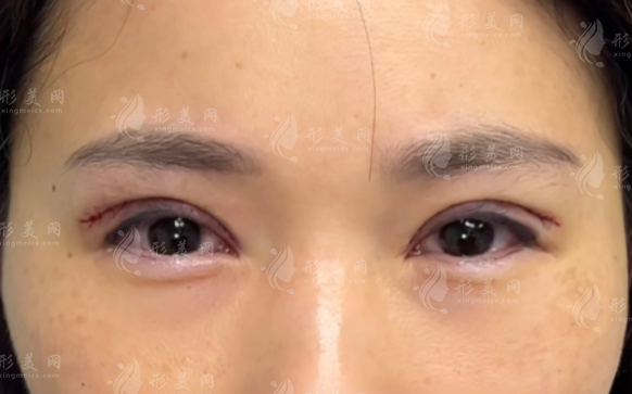 北京张冰洁眼修复技术怎么样?真实评价揭秘不踩坑 北京张冰洁眼修复技术怎么样?真实评价揭秘不踩坑