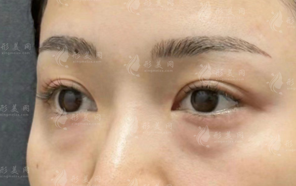 广州去眼袋哪家医院好?排名前五整形医院技术靠谱口碑佳