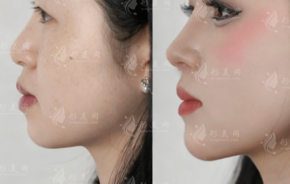 隆鼻后鼻子不舒服?教你分辨假体过敏与排异反应 隆鼻后鼻子不舒服?教你分辨假体过敏与排异反应