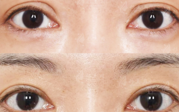 上海马娟双眼皮修复靠谱吗?技术口碑+价格全解析 上海马娟双眼皮修复靠谱吗?技术口碑+价格全解析