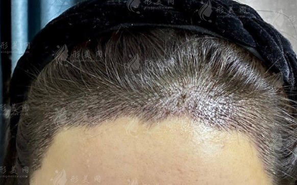 沈阳华美植发医院正规吗?资质揭秘+医生技术全解析