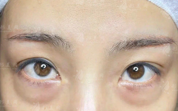 沈阳美莱祛眼袋怎么样?医生技术+价格表全揭秘