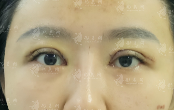 石家庄双眼皮修复哪家好?靠谱医院医生排名推荐