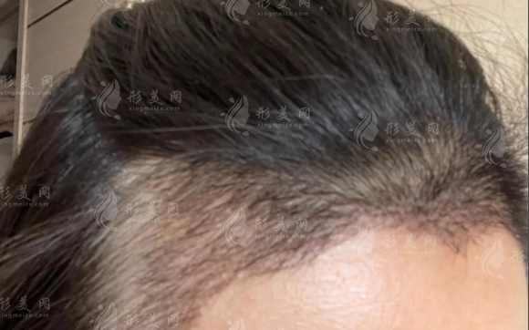 上海植发医院排名前十：技术好价格便宜的正规医院推荐