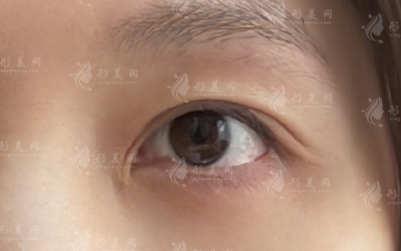 上海双眼皮修复选谁好?张园园/许炎龙技术风格深度解析