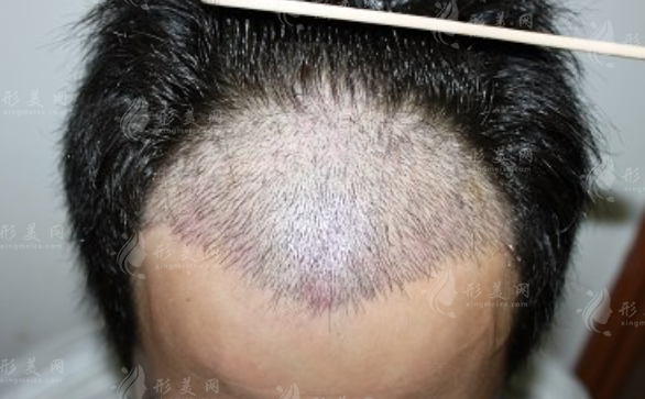 国内连锁植发医院哪家好?十大正规机构排名及春草植发地址价格