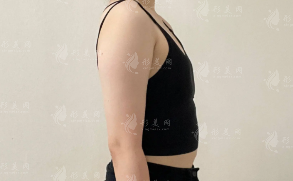 成都隆胸选哪家?后美薛瑞vs美莱熊猛技术审美大比拼