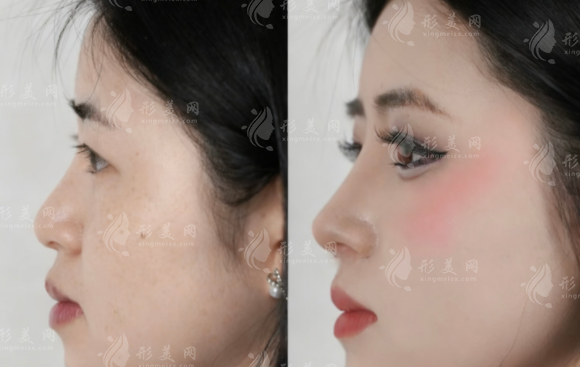 玻尿酸隆鼻能挺多久?6-12个月维持秘诀全揭秘