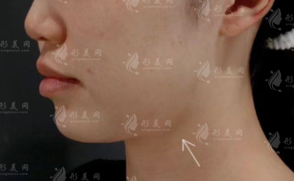 朴正国做下颌角怎么样?长曲线截骨技术口碑价格全解析