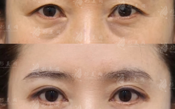 哈尔滨羽禅杨宇梓怎么样?20年眼整形经验技术口碑全解析