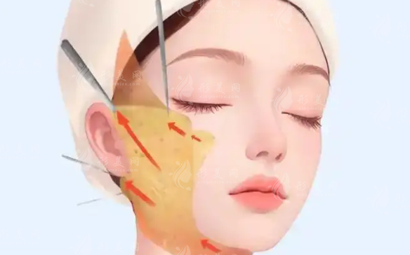 筋膜提升能维持几年?1-3年常见4大关键因素揭秘