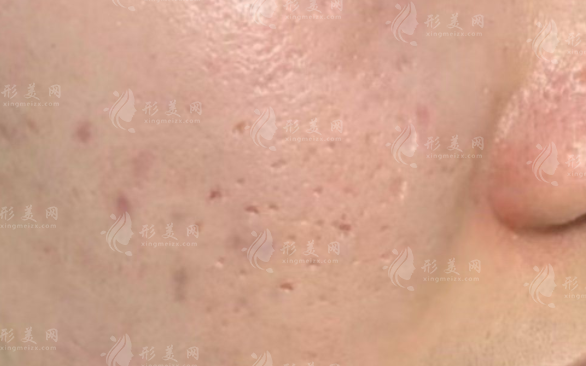 昆明点阵激光祛痘坑哪家好?这6家医院口碑爆棚附价格表!