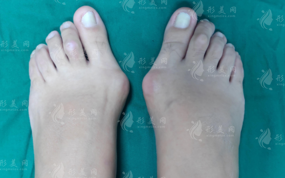 苏敬达和马桂文做大脚骨谁更好?技术风格价格全面对比