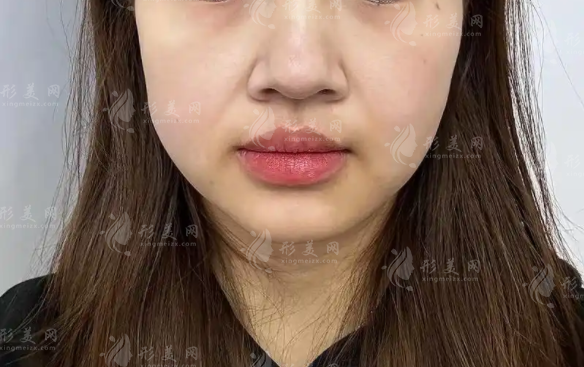 隋冰馒化脸修复效果好吗?价格成效及医生实力深度测评