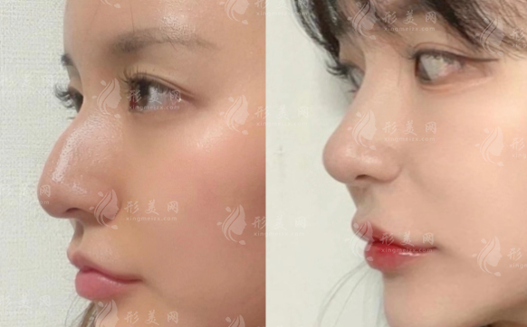 怎么找深圳文丰医生做鼻子?从预约到面诊全指南