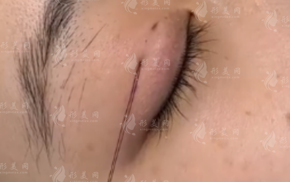 2026上海埋线双眼皮医院哪家好?美莱华美技术实力大比拼