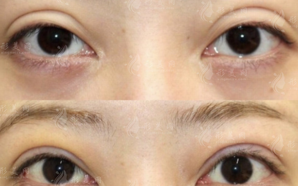 上海张园园和许炎龙双眼皮修复哪个好?深度对比两人风格/网友真实口碑与技术点
