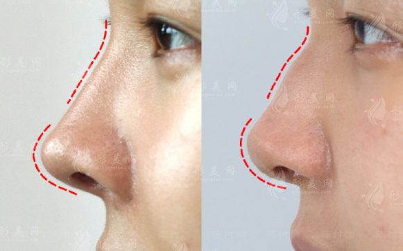 长春悦美汇孟宪勇鼻修复怎么样?价格技术口碑全揭秘