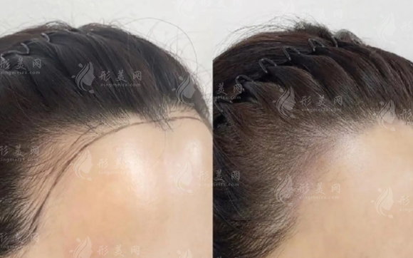 国内十大连锁植发医院排名：春草植发分院地址价格一览