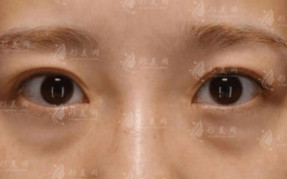 光能祛眼袋效果好吗?和激光祛眼袋区别在哪?90%人分不清