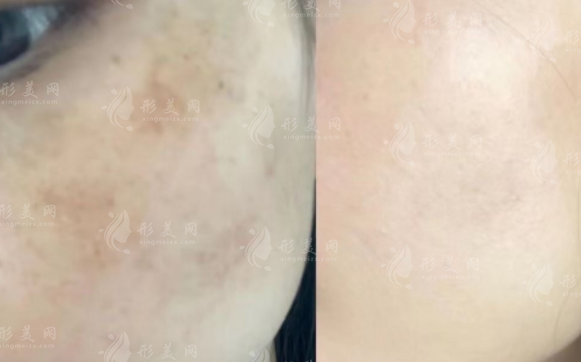超皮秒除了祛斑还能干啥?5大隐藏功能全揭秘