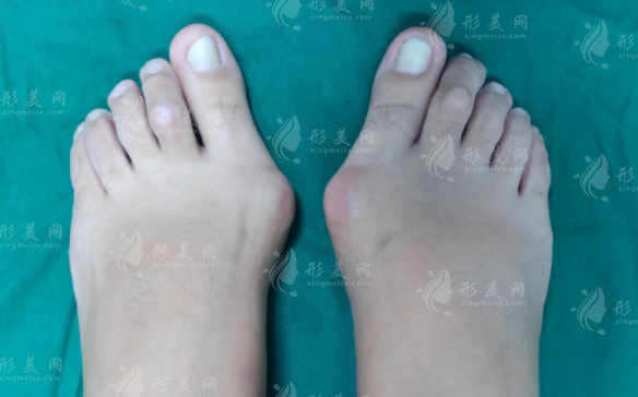 苏敬达和马桂文做大脚骨谁好?技术风格与价格全面对比