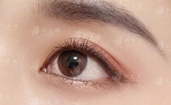 郑州蔡连朋双眼皮技术怎么样?同乐医院坐诊自然无痕