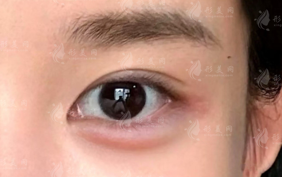 郑州王杨医生卧蚕修复多少钱?2026价格表及眼袋费用一览 郑州王杨医生卧蚕修复多少钱?2026价格表及眼袋费用一览