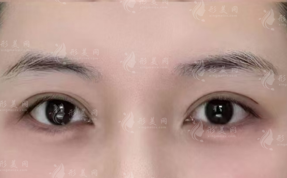 北京双眼皮修复哪个医生好?于建华/师丽丽/魏志香凭实力出圈 北京双眼皮修复哪个医生好?于建华/师丽丽/魏志香凭实力出圈