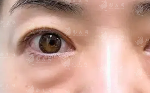 合肥祛眼袋哪个医院好?壹加壹/艺星/韩美/维多利亚/华美推荐