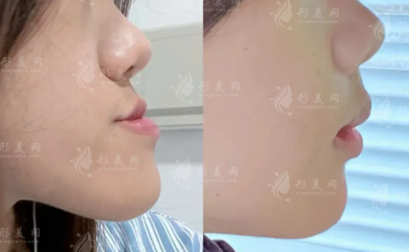 吴训医生正颌手术多少钱?2026单颌/双颌/颏成型价格表